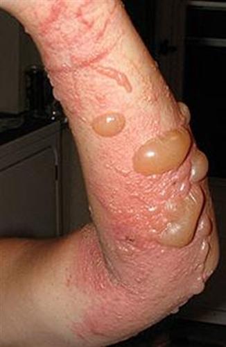 Erbe per cura di psoriasi